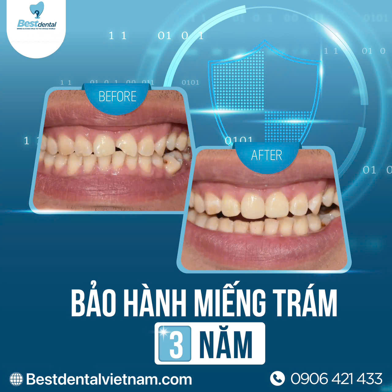 Miếng trắm răng tại nha khoa Best được bảo hành 3 năm sau khi trám