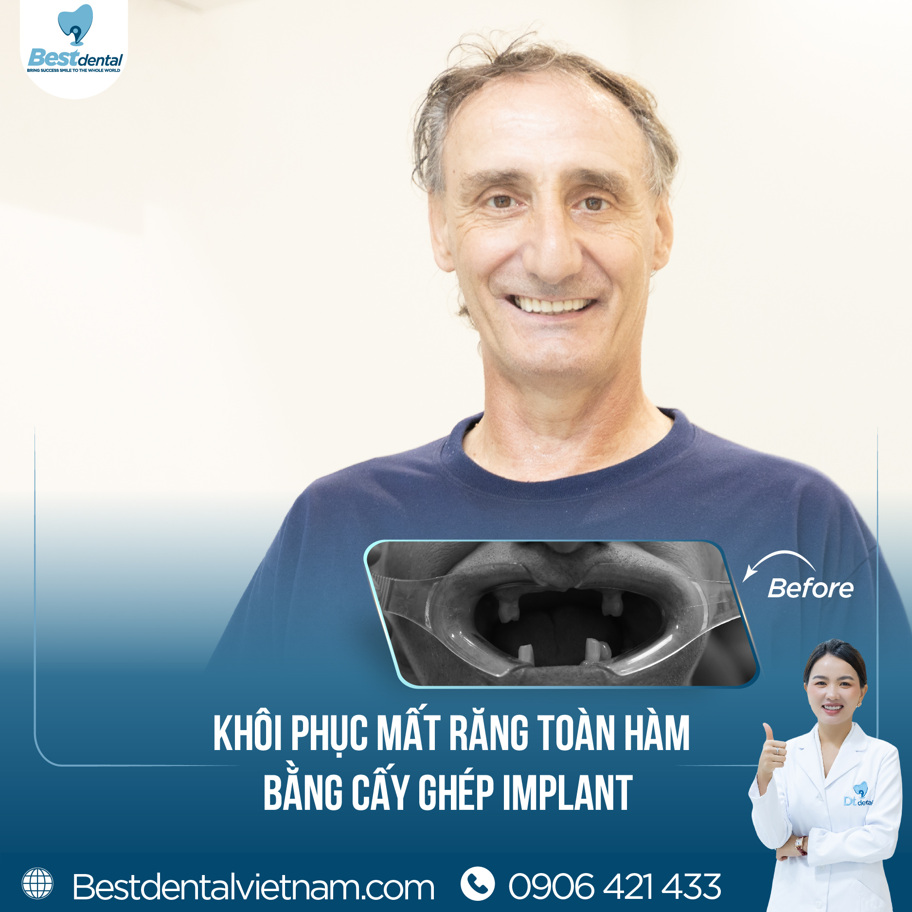 trồng răng implant phương pháp hiệu quả tuyệt vời cho người mất răng