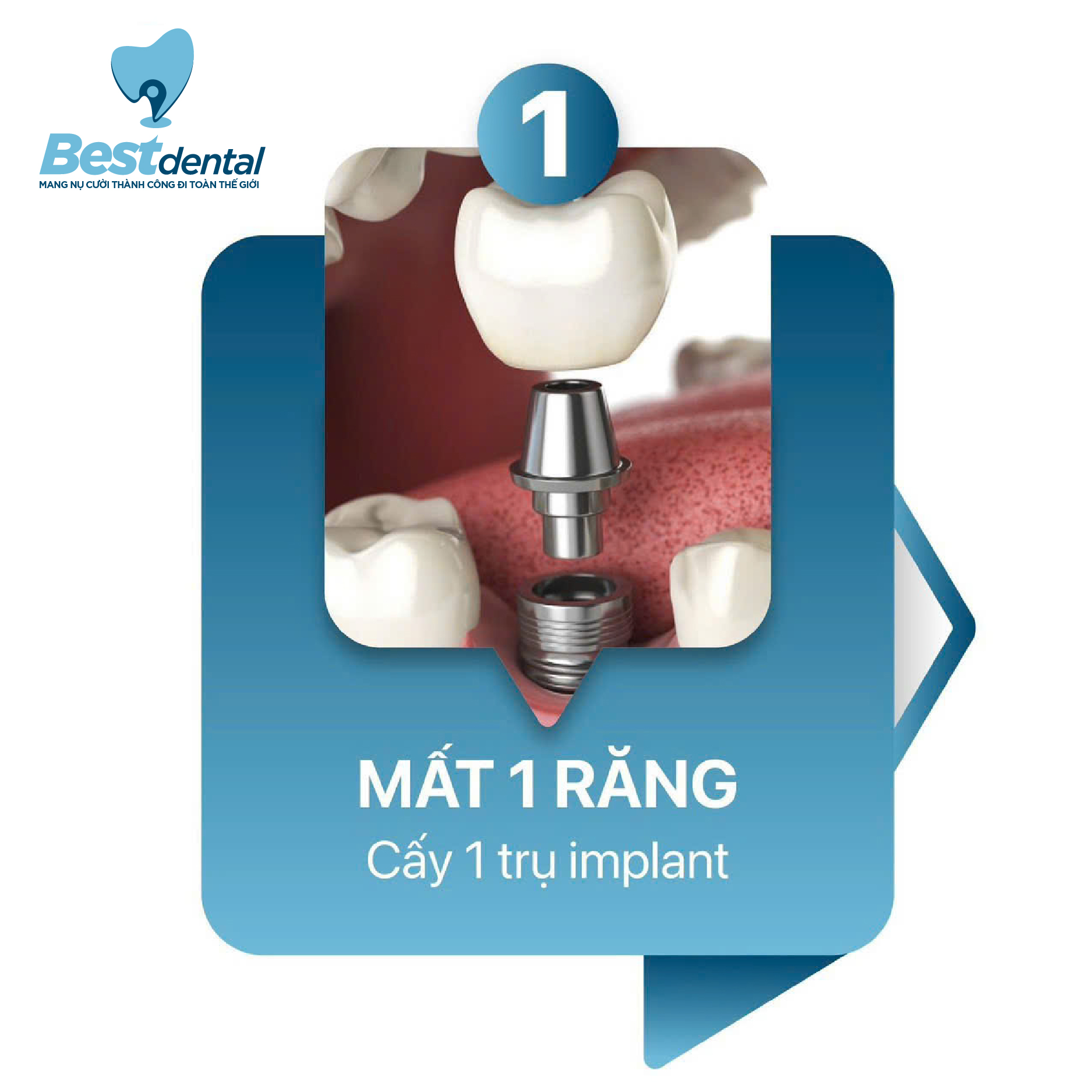Cấy ghép implant cho răng đã mất