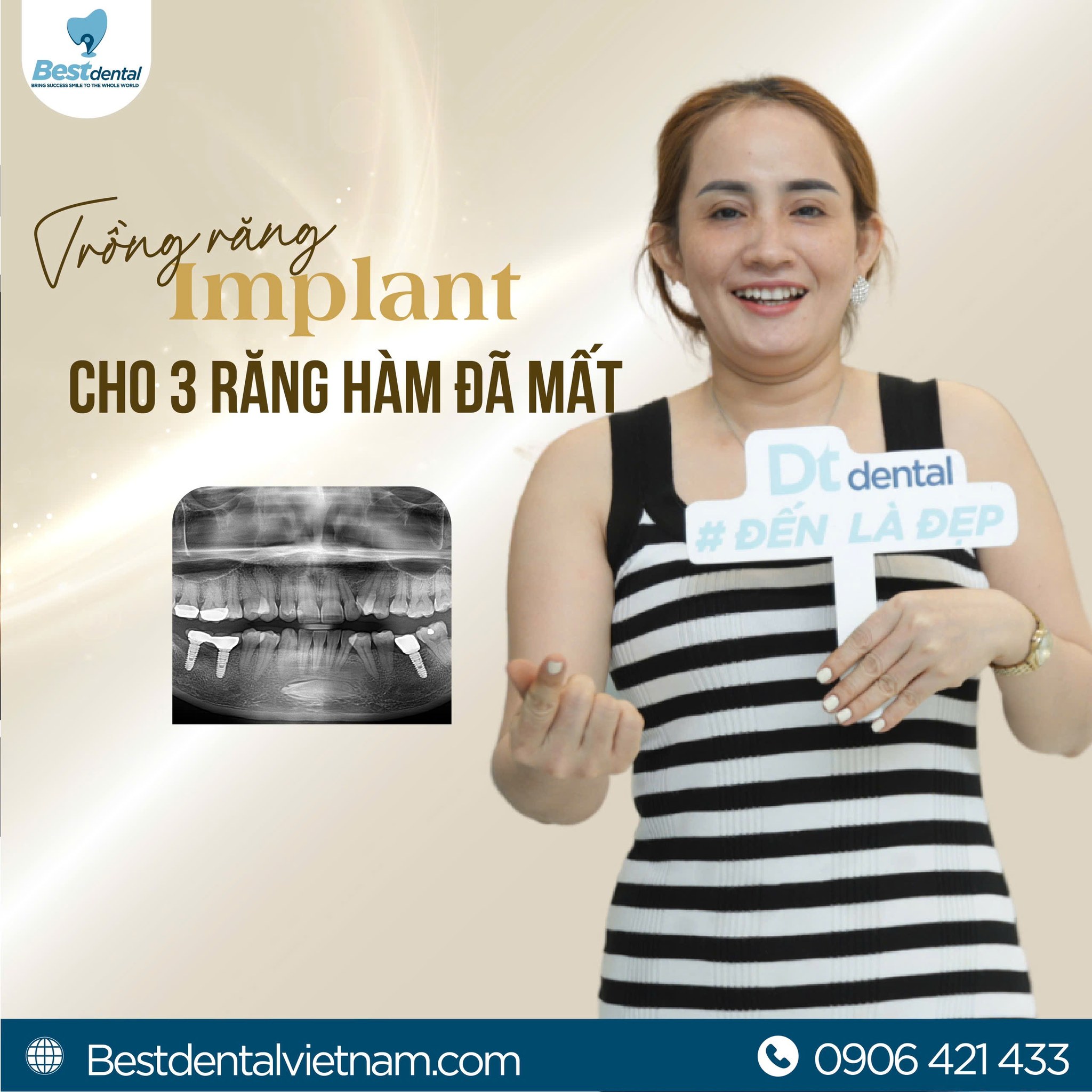 Cấy ghép implant cho răng hàm tại nha khoa Best Thủ Đức