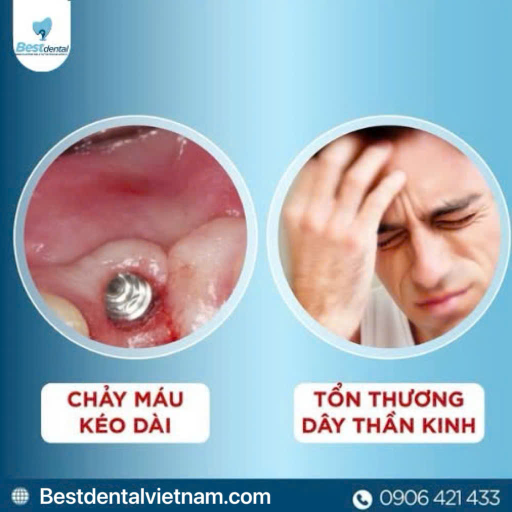 trồng răng implant không chất lượng có thể gây ra rất nhiều biến chứng khác nhau