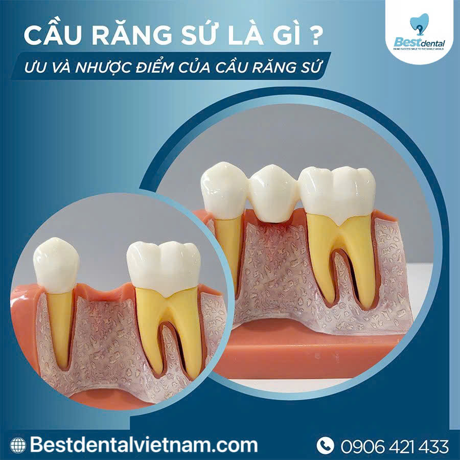 mài hai răng bên cạnh mài nhỏ để tạo thành cầu 3 răng thay thế cho một răng đã mất