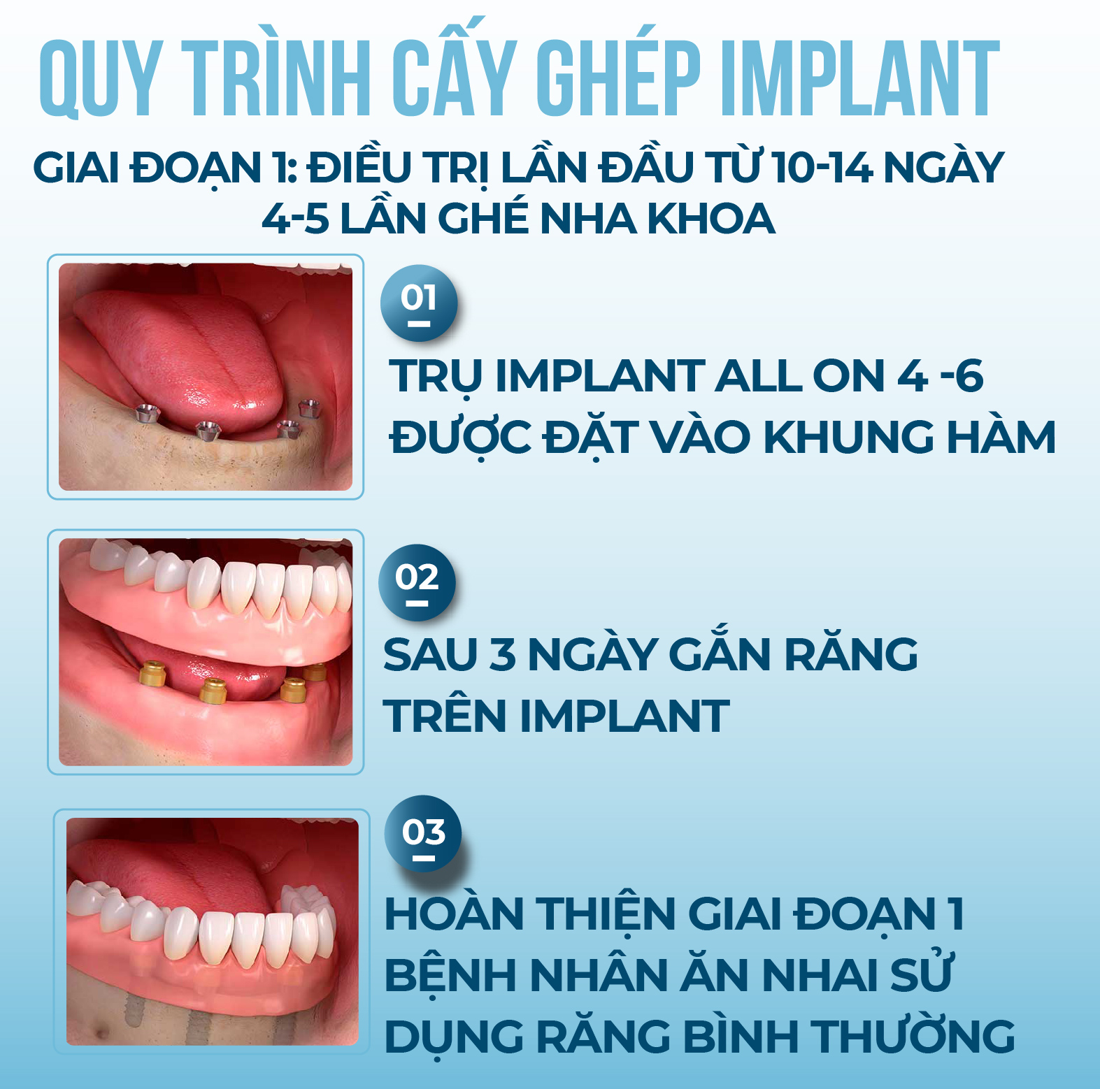 Quy trình trồng răng Implant toàn hàm