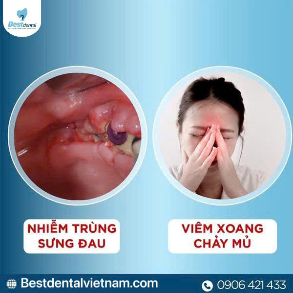 biến chứng nhiễm trùng gây sưng đau, viêm quanh chân implant