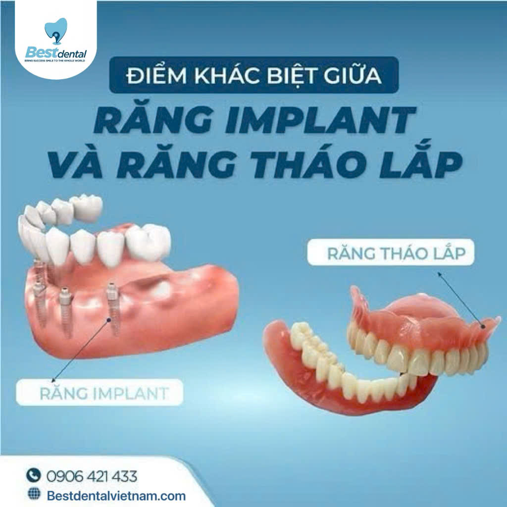 hàm tháo lắp và trồng răng cố định