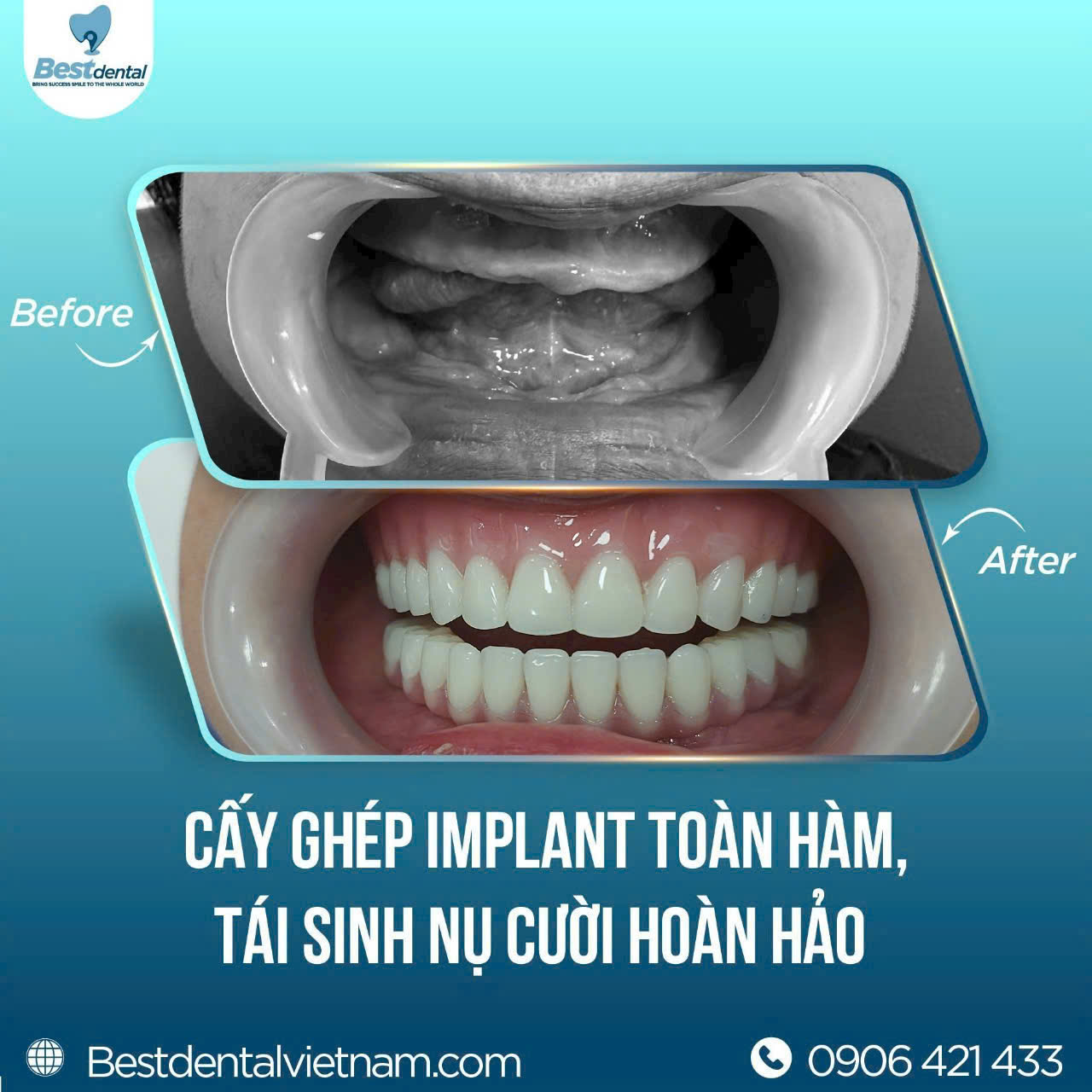 cấy ghép implant toàn hàm mang lại giá trị cao