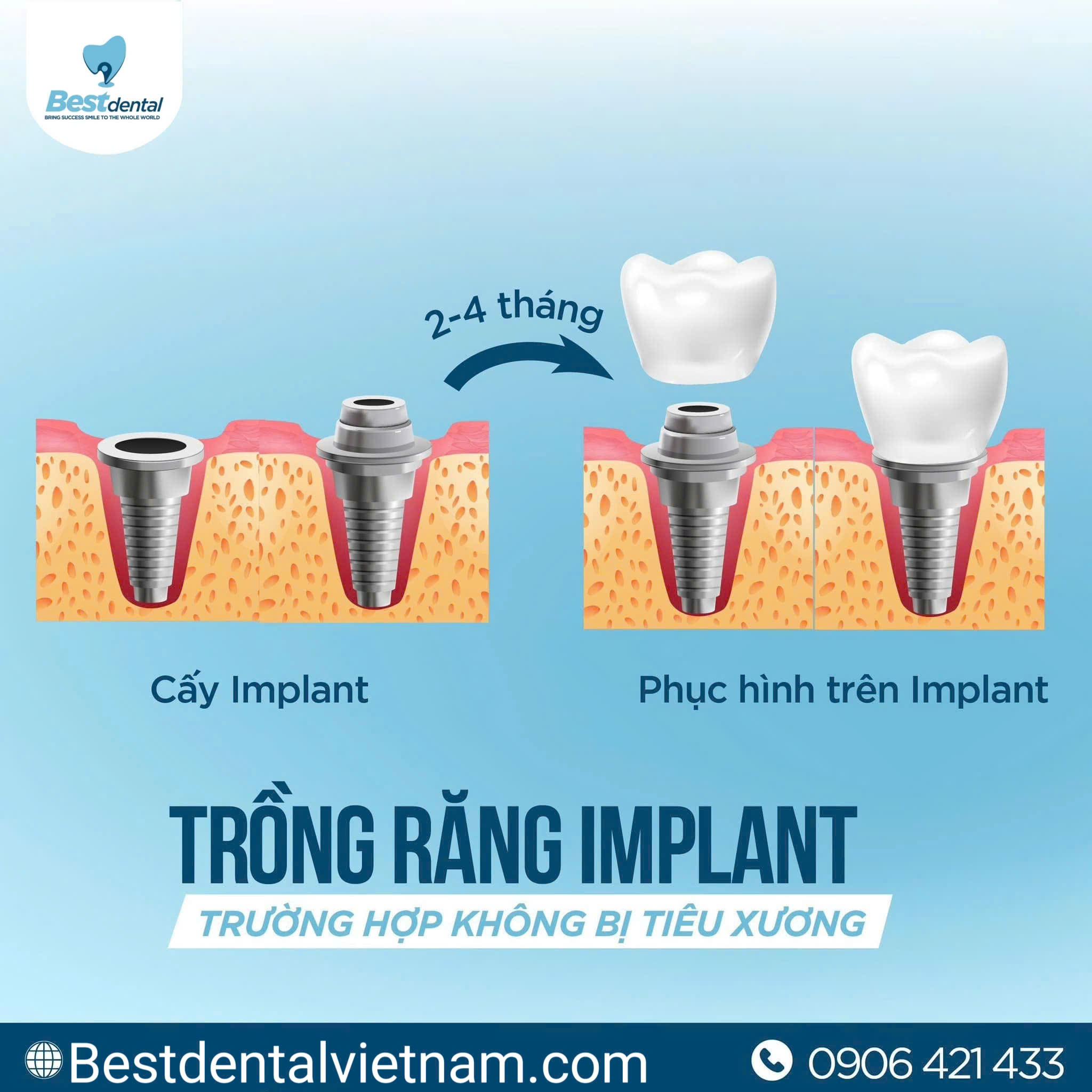 Mô phỏng quá trình cấy ghép Implant vào xương hàm