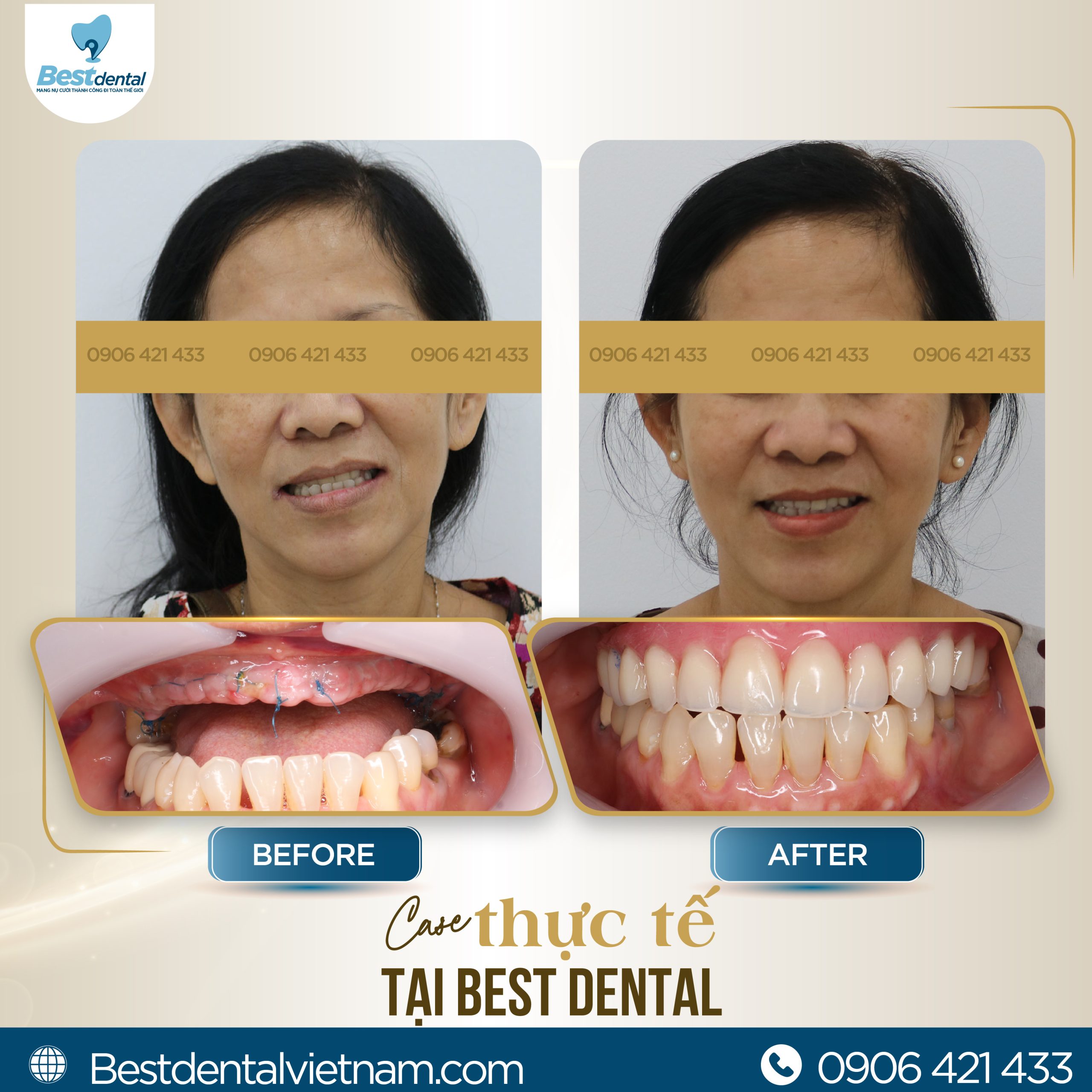 Trước và sau khi trồng răng Implant toàn hàm